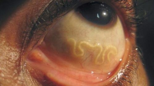 Parasite in the human eye