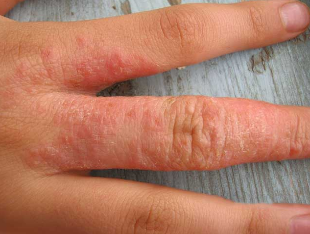 Rashes on the skin in the case of the worms